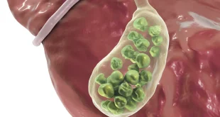 penyebab batu empedu